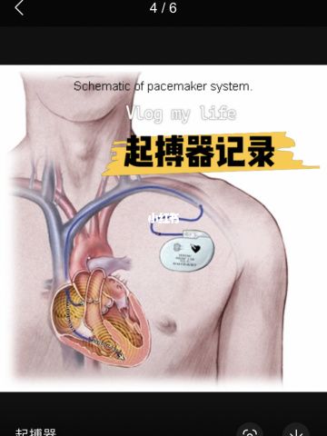 国产心脏起搏器