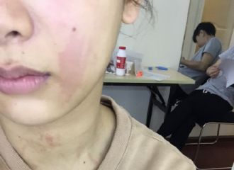 杨紫出荨麻疹满脸红痕，“秋后算账”的皮肤病究竟为何而来？