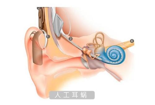 助听器是什么？