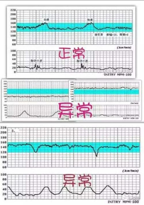 为什么临产的时候，一直得使用胎心监护仪呢？