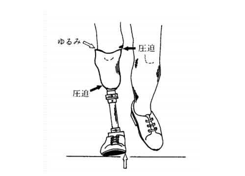 假肢的定义