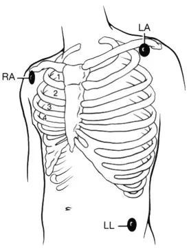 心电监护电极片RA、RL、C、LA、LL的安装位置分别在哪里？