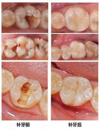 补牙材料有哪些？