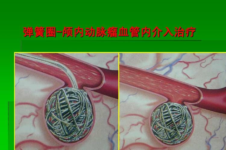 请问脑动脉瘤介入手术用到的弹簧圈、医用支架在河北省新农合报销范围内吗？还有大病险怎么个报销流程？